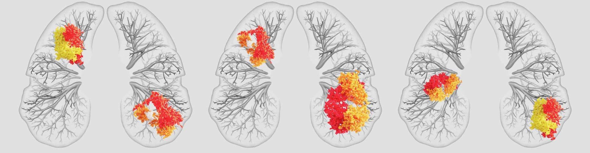 Automated Lung Pathology Detection with an AI Chest X-Ray Tool cover